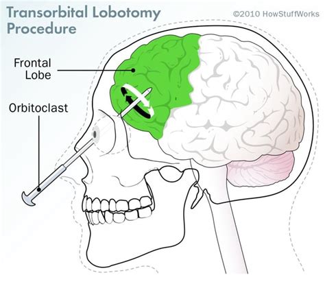 lobotomy piercing|what is a transorbital lobotomy.